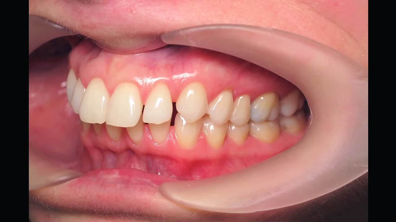 Holly'S Invisalign | Before And After | Dr. Jason Tubo | Northbridge Dentist