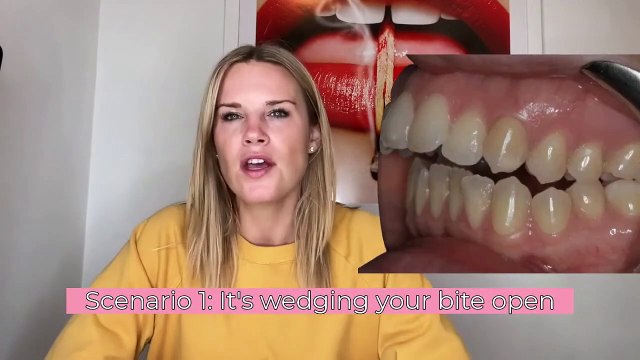 Wisdom Teeth Removal Before Invisalign In 2021 | Yes Or No? Top 3 Scenarios Where I Say Get 'Em Out