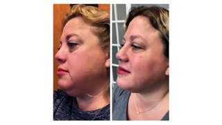 Kybella Before & After Treatment Journey With Cosmetic Injector Erin Jedrusik | Revival Rn