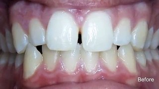 Invisalign Before And After Pictures - Invisalign In Toronto With Mco Orthodontics