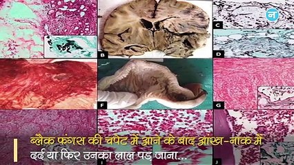 कोरोना से संक्रमितों पर कहर बनकर टूट रहा ब्लैक फंगस! जानें इसके लक्षण और बचने का तरीका