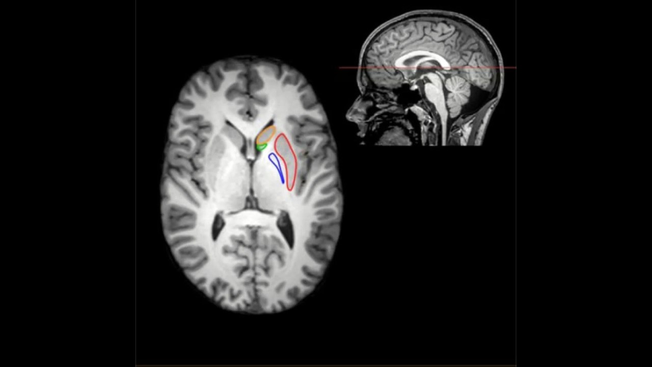 988Hz Basal Ganglia