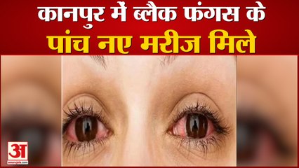 कानपुर में ब्लैक फंगस के पांच नए मरीज मिले