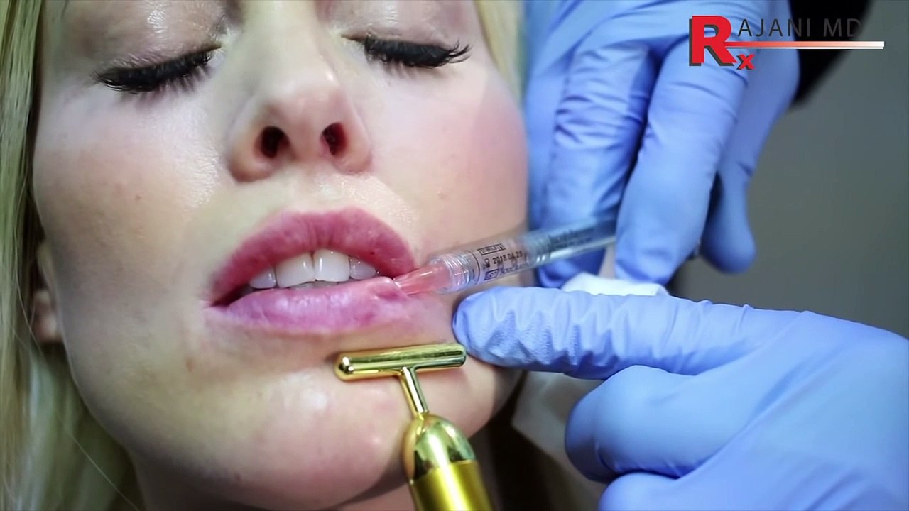 How To Fix Lip Filler Bumps And Lumps-Why And How