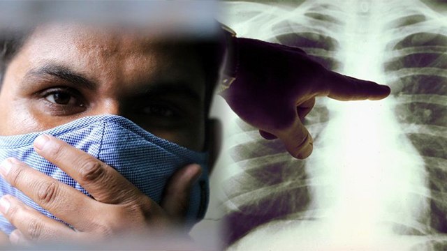 क्या Black Fungus किसी भी Covid 19 Patient को हो सकता है, Experts Advice | Boldsky