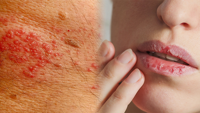 Coronavirus का New Symptoms आए सामने, Skin और Nails पर फैला रहा Infection | Boldsky