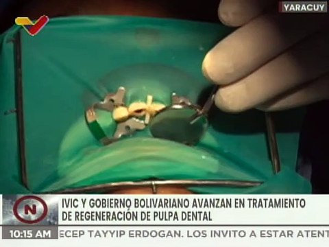 Yaracuy | Misión Sonrisa y el IVIC realizan tratamiento con células madre a 50 pacientes