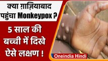 Ghaziabad: 5 साल की बच्ची में मिले Monkeypox जैसे लक्षण, लिए गए सैंपल | वनइंडिया हिंदी | #News