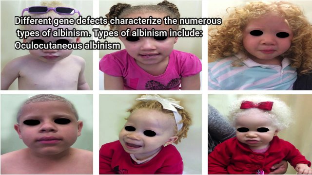 Albinism