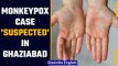 Monkeypox-like symptoms suspected in a Ghaziabad girl, health officials alerted | OneIndia News