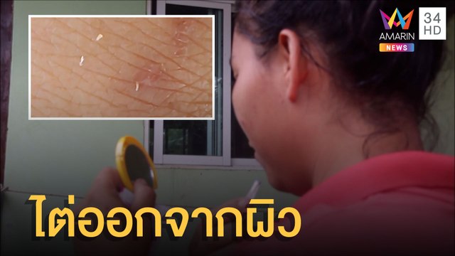 สุดช็อก ตัวประหลาดคล้ายหนอนไต่ออกจากผิวหนัง | ข่าวเที่ยงอมรินทร์ | 6 มิ.ย.65