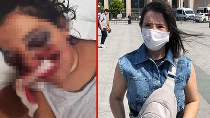 Tatilde ATV'ye bindi, sağ gözünü kaybetti! Yüzde 46 engelli kalan kadın şimdi adalet istiyor