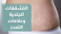 ما اسباب ظهور التشققات الجلدية وعلامات التمدد