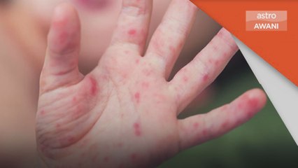 HFMD | Pulau Pinang rekod 3012 kes, meningkat 20 kali ganda