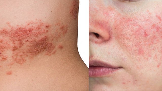 गर्मी में Rashes क्यों होते है | ये Rashes Remedies जरूर अपनाएं | Boldsky *Health