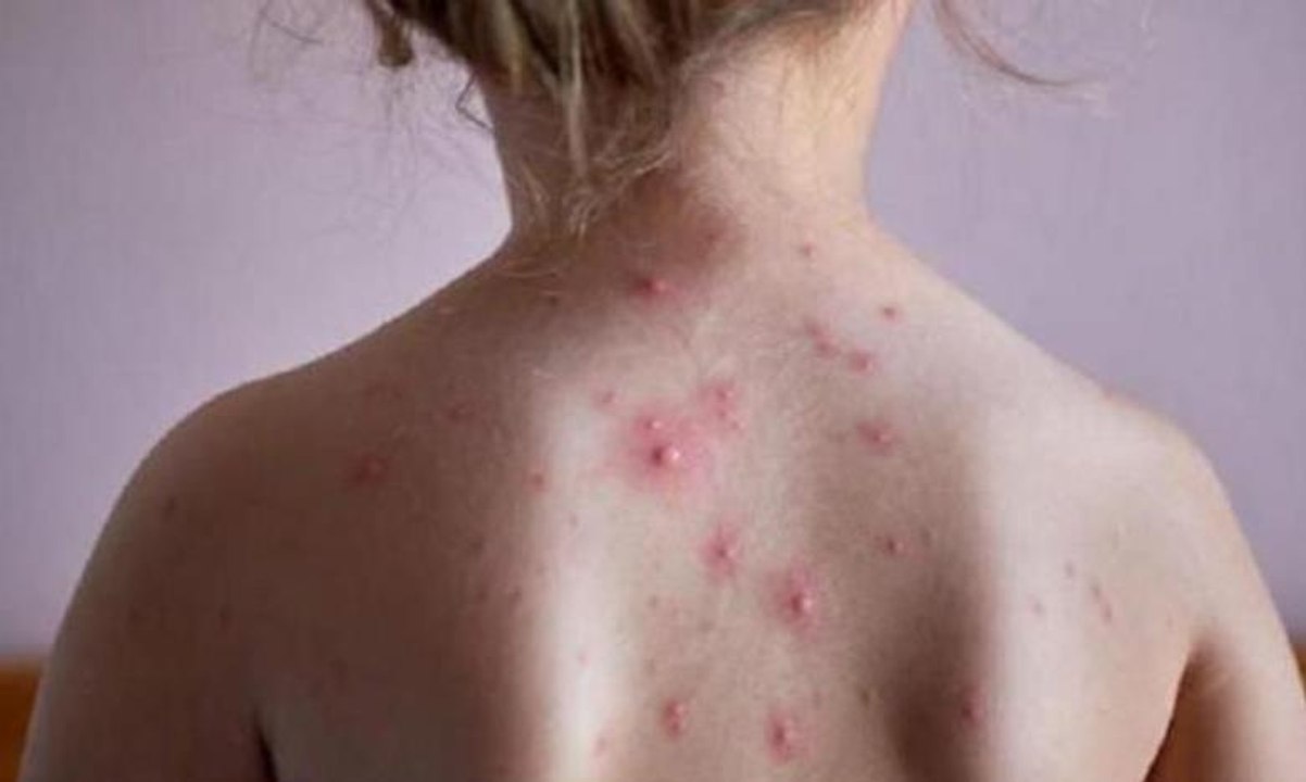 عوارض جدري القردة تختلف عن عوارض جدري الماء