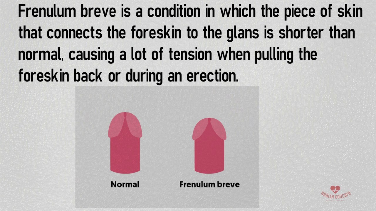 Short Frenulum/Tight frenulum - Foreskin problem