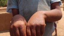 انتشار الأمراض الجلدية في اليمن