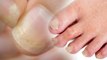 Corona Recovery के बाद Patients के Nails में दिखे ये नए Symptoms | Boldsky