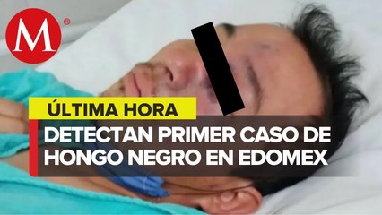 Esto se sabe del primer caso de Hongo Negro en EdoMex