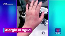 El extraño caso de Tessa, la joven que es alérgica al agua