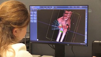 CyberKnife cihazı, vücuttaki kanserli hücrelerin tedavisinde kullanılıyor.