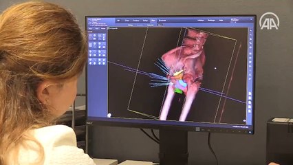 Robotik radyocerrahi cihazı "Uzay Neşteri" kanser tedavisinde etkin rol üstleniyor
