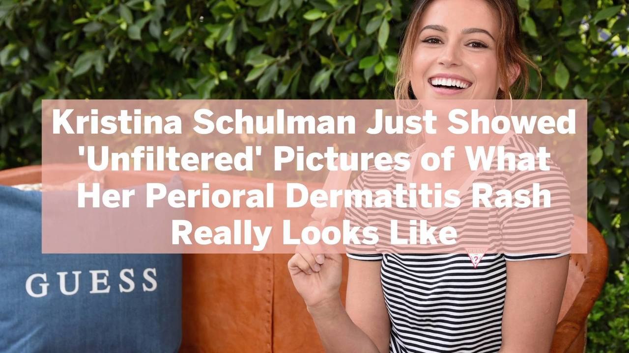 Kristina Schulman Just Showed ‘Unfiltered’ Pictures of What Her Perioral Dermatitis Rash R