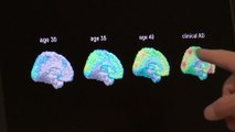 Dopo 20 anni approvato un farmaco per l'Alzheimer. Ma la comunità scientifica è divisa