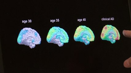 В США дают надежду больным Альцгеймером