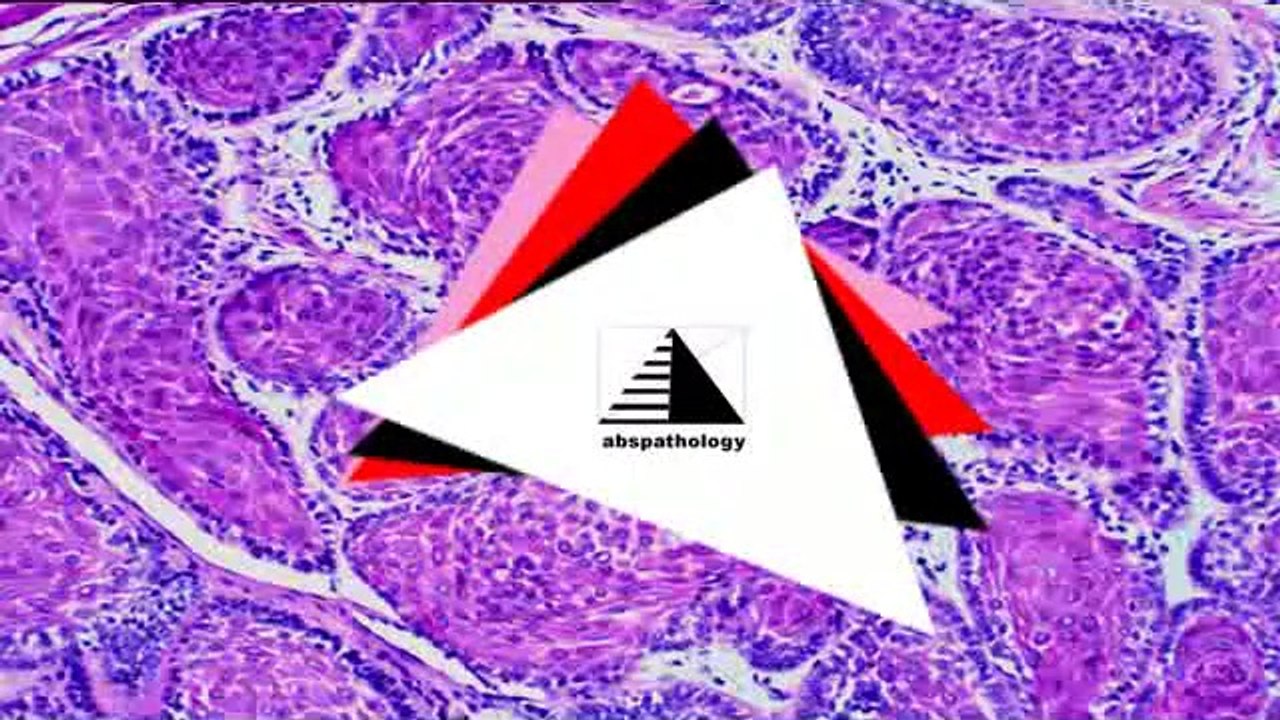 AMELOBLASTOMA RECIDIVA: SIMPLES CURETAGEM MAIS CRIOTERAPIADE AMELOBLASTOMA CONVENCIONAL