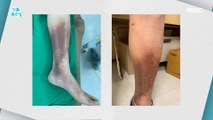 [HEALTHY] If you leave the varicose veins unattended, your skin will rot?, 기분 좋은 날 210609