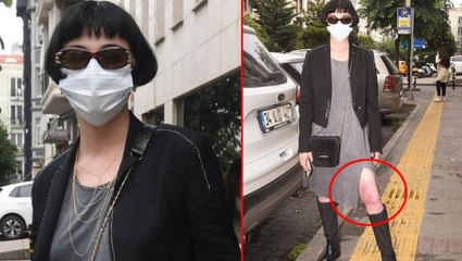 Vücuduna kaynar su dökülen Gonca Vuslateri, yanık bacağının son halini gösterdi