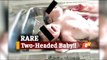 Baby Girl With 2 Heads Born In Odisha’s Kendrapara, Shifted To Cuttack Shishu Bhawan | OTV News