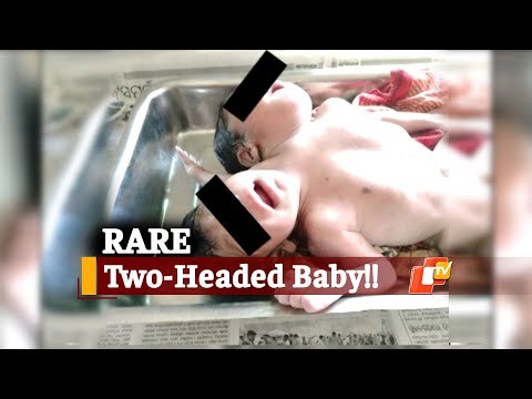 Baby Girl With 2 Heads Born In Odisha’s Kendrapara, Shifted To Cuttack Shishu Bhawan | OTV News