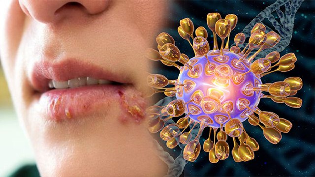 Corona Recovery के बाद फैला Herpes Simplex Virus, Symptoms चौंकाने वाले | Boldsky