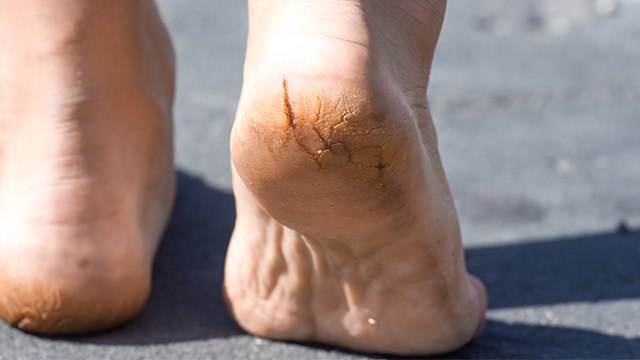 फटी एड़ियों की असली वजह है इस Vitamin की कमी | Cracked Heels Vitamin Deficiency | Boldsky