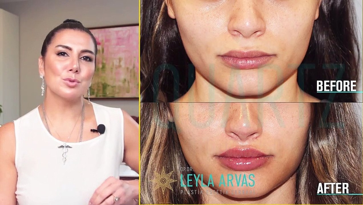 DUDAK DOLGUSU | LİP LİFT AMELİYATI YAPILIR MI!  | Op. Dr. Leyla Arvas