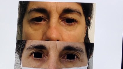 Dott. F.Madonna Terracina  La bleferoplastica