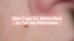 Skin Tags Vs. Moles-How to Tell the Difference