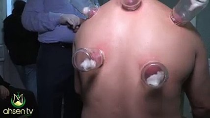 Hacamat nedir, nasıl yapılır ve nelere iyi gelir