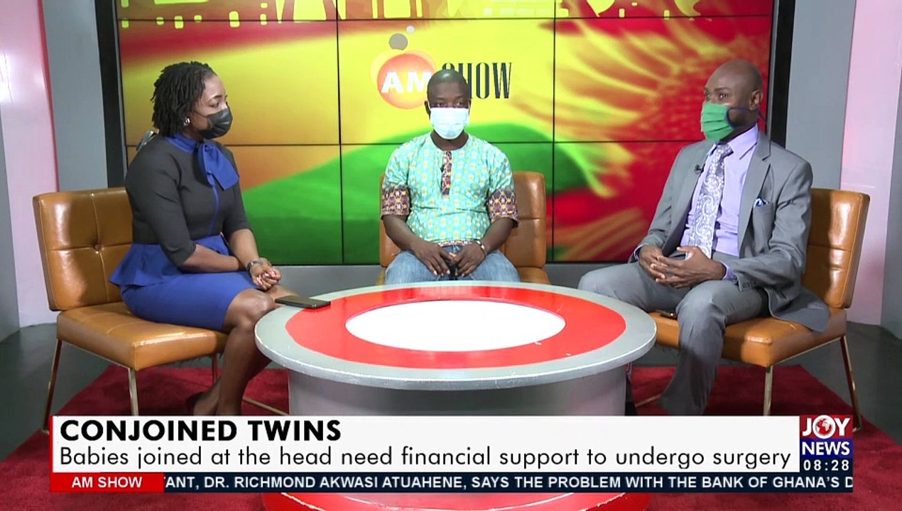 Conjoined Twins: Babies joined at the head need financial support to undergo surgery (14-6-21)