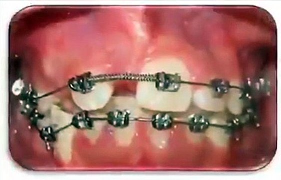 Comment un appareil dentaire corrige la dentition ?