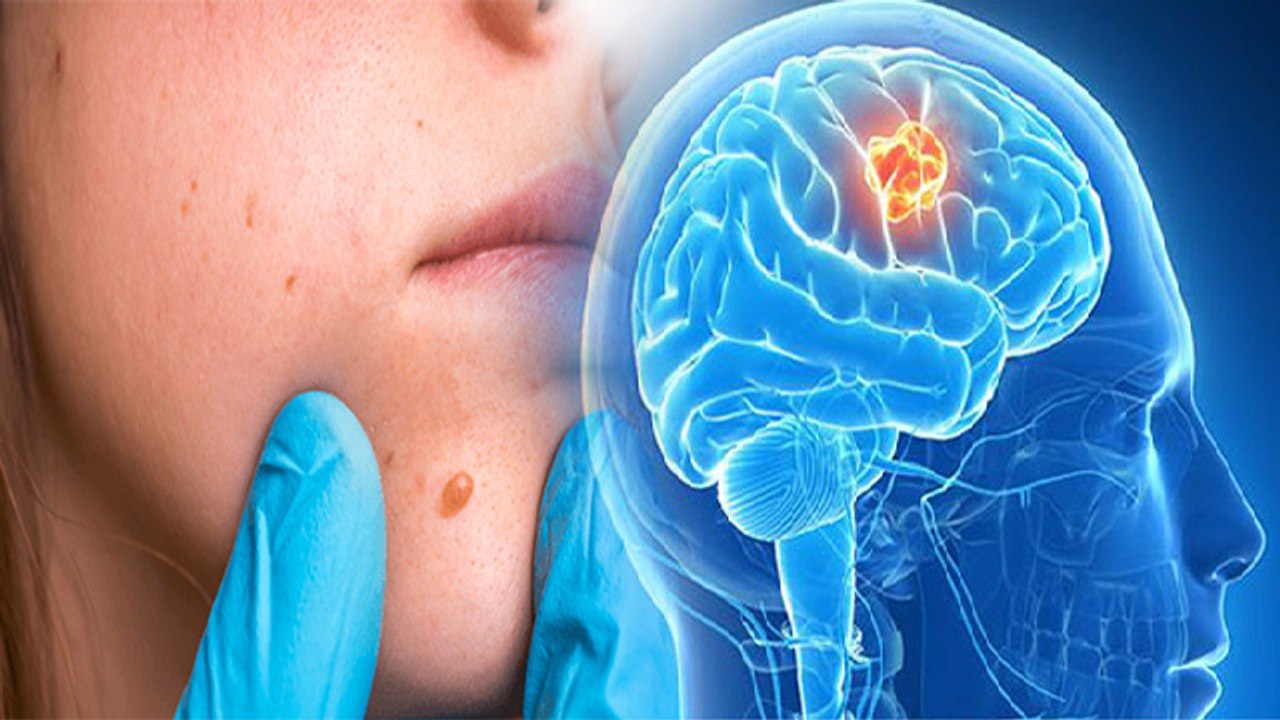 दिमाग से शरीर के दूसरे हिस्से में फैल रही खतरनाक बीमारी, हो जाएं सावधान | Benign Tumor Symptoms