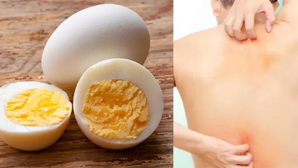 Egg से Allergy है या नहीं ऐसे करें पहचान। Egg Allergy के लक्षण और कारण । Boldsky