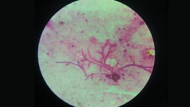 India के Patient में मिला Black White Fungus एक साथ, चौंकाने वाला Case | Boldsky