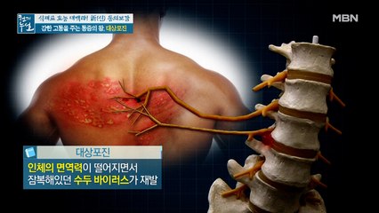 강한 고통을 주는 통증의 왕 '대상포진'을 주의하라!