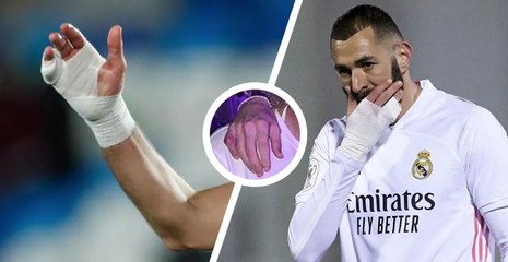 Voilà pourquoi Benzema porte constamment un bandage à la main lors des matchs