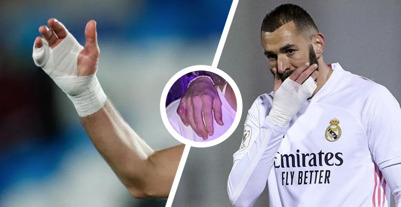 Voilà pourquoi Benzema porte constamment un bandage à la main lors des matchs