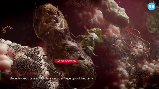 Black Fungus in Covid-19 patients I Mucormycosis I Warning Signs & Treatment I Dr. Mathew Varghese